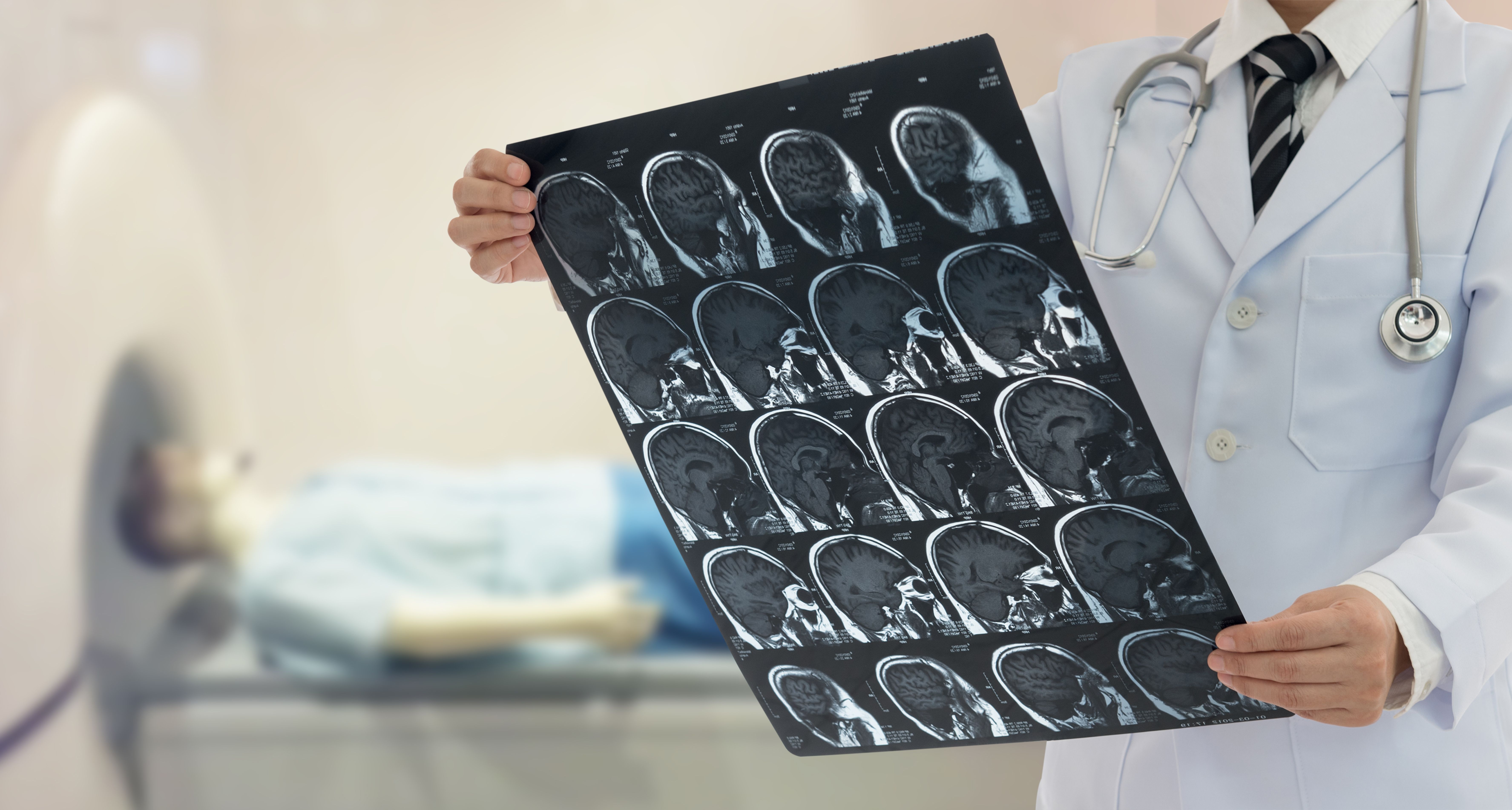 Acidente Vascular Encefálico Isquêmico e suas principais complicações