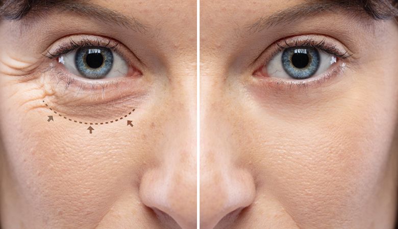 Blefaroplastia: Tratamento estético e funcional para a saúde ocular