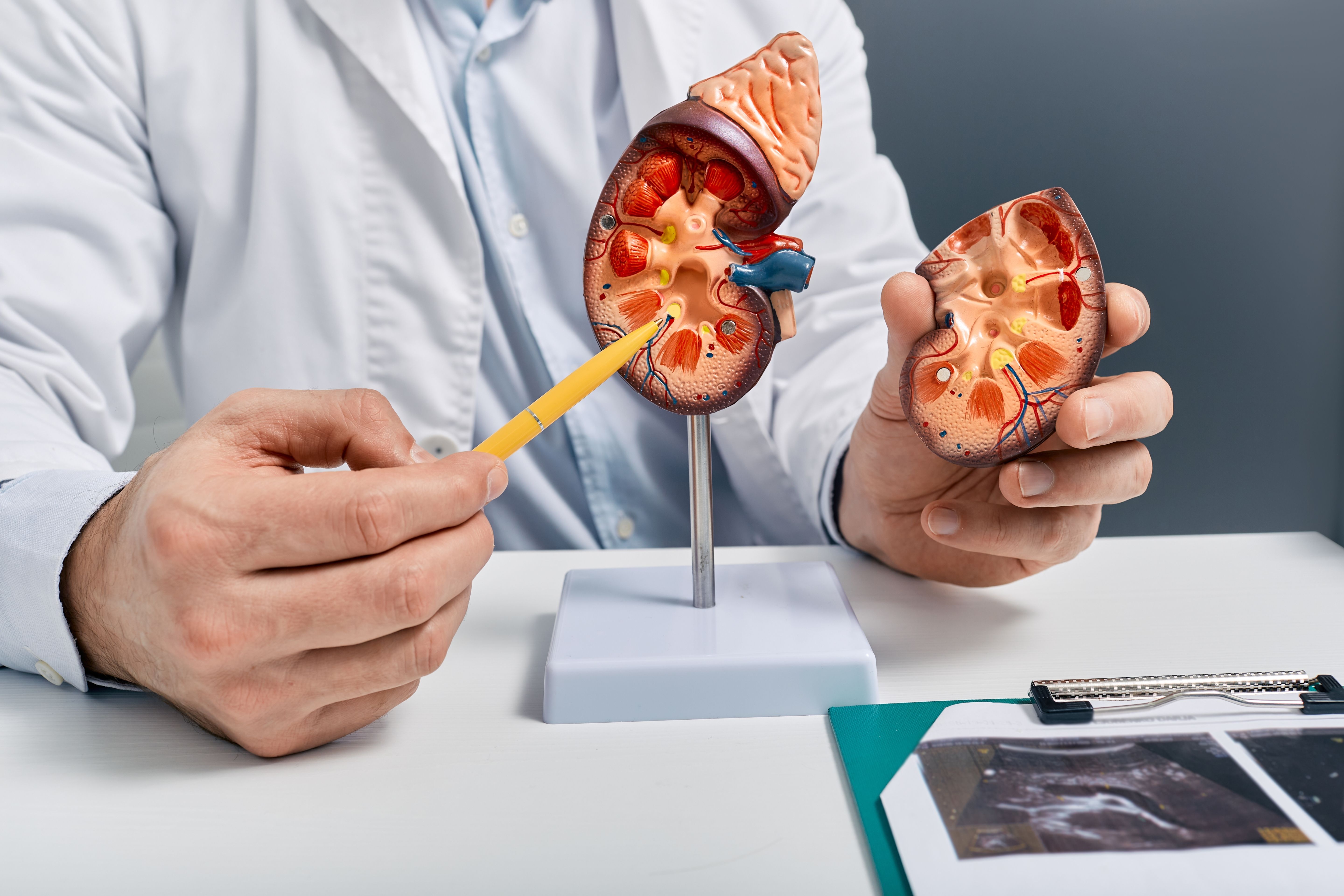 Cálculo Renal: 10 causas para pedras nos rins e como preveni-las